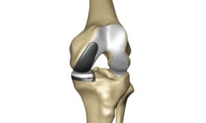 Digital model of a total knee replacement