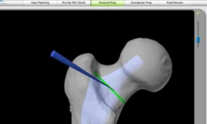 3D Modeling for Hip Replacement Planning