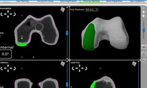 Computer modeling of a knee for surgical planning