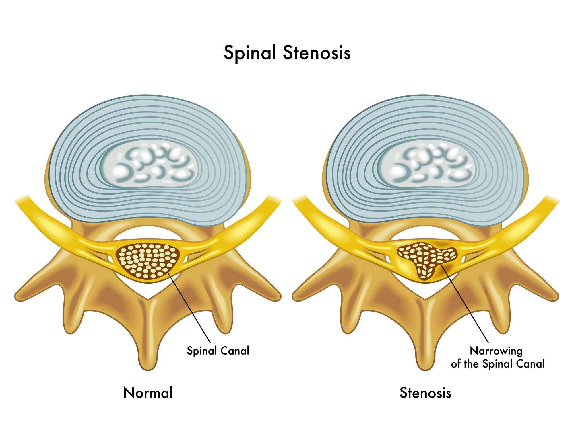 Dr. Ed Becker breaks down the frequently asked question: What is Spinal Stenosis?