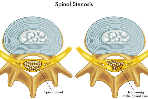 What is Spinal Stenosis Post