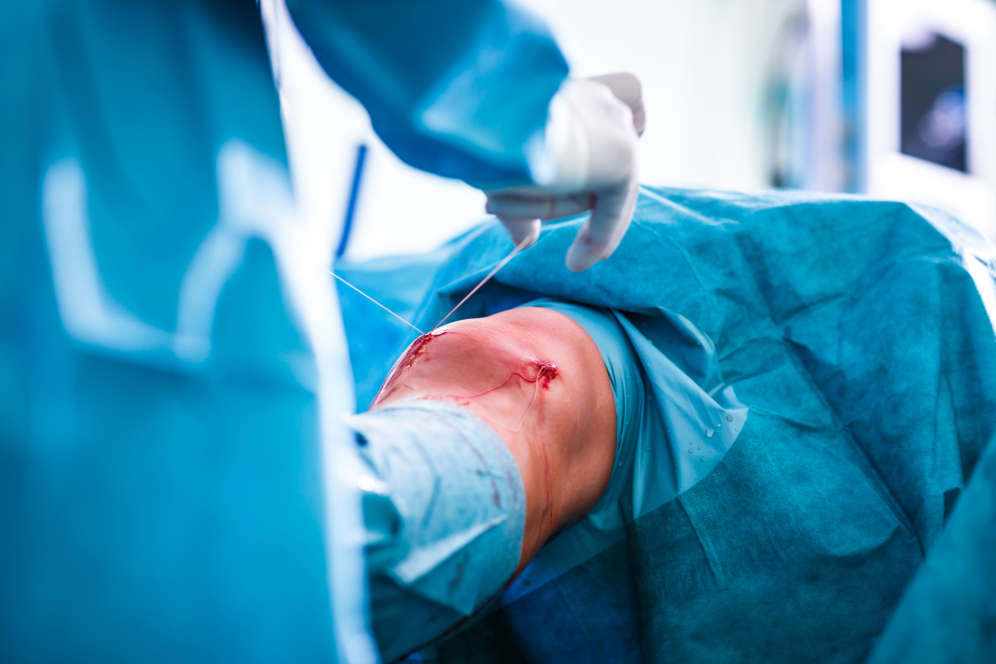 Knee Surgery - Choosing an ACL Graft Type