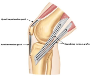 ACL Graft Options