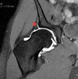 MRI showing labral tear – red arrow