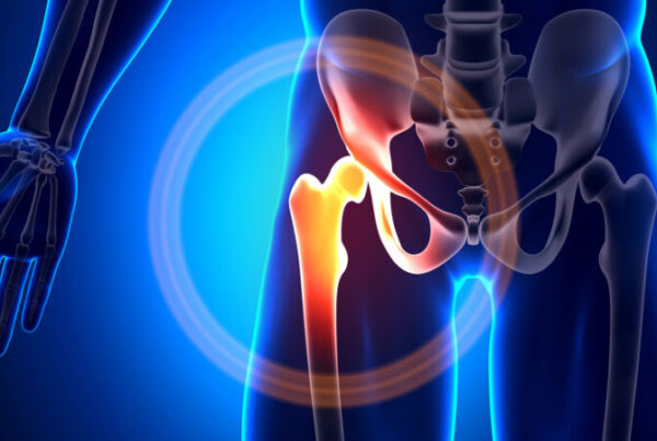 Symptoms, Diagnosis, and Treatment of Femoral Acetabular Impingement Post