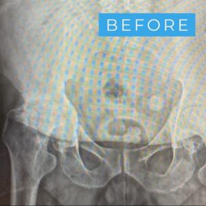 hip replacement before photo
