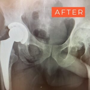 hip replacement after photo
