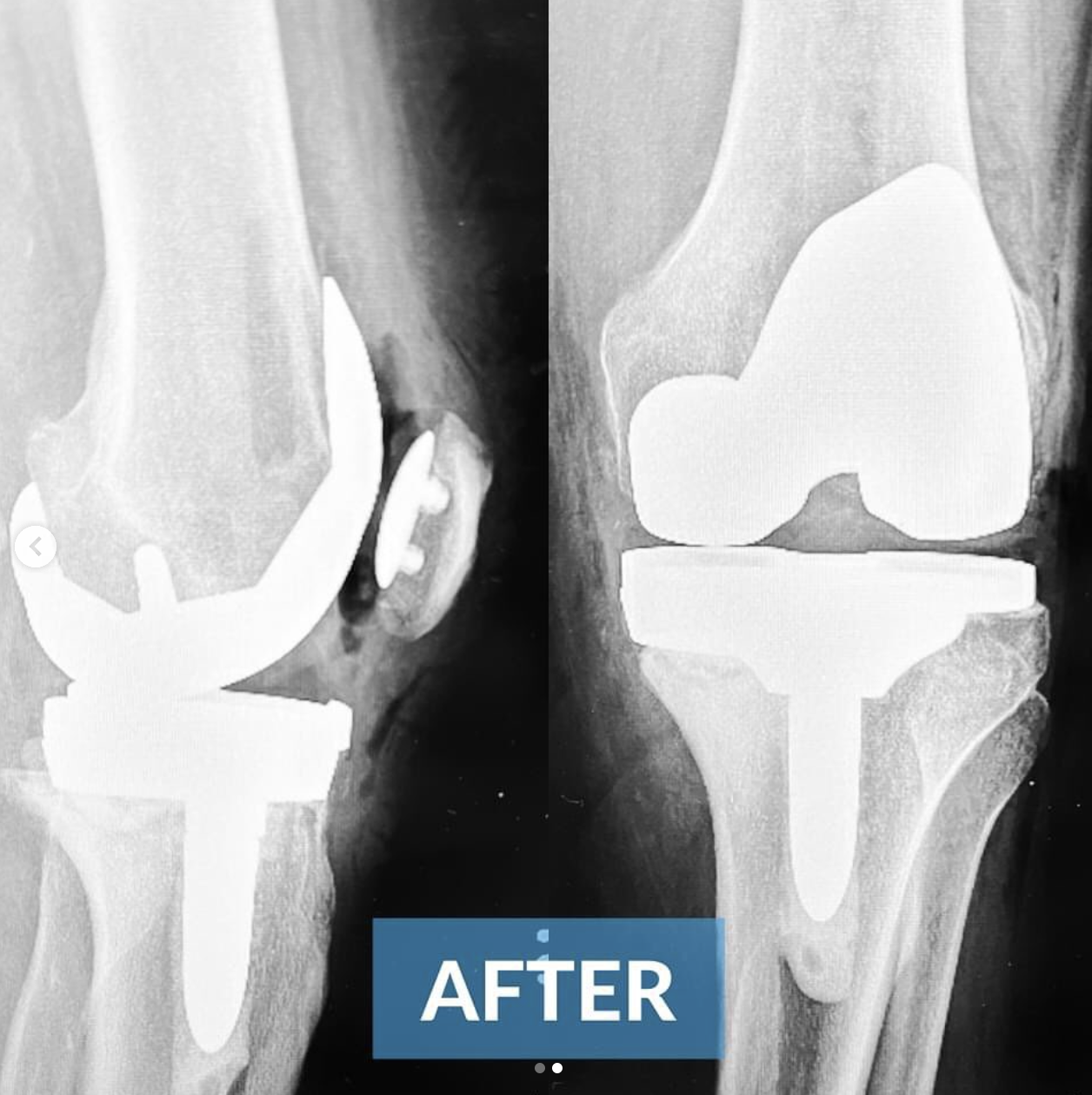 knee replacement surgery after photo