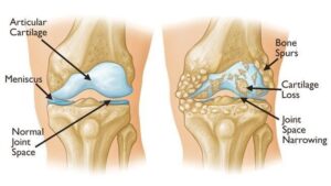 Sample-of-Normal-Knee-and-osteoarthritis-knee