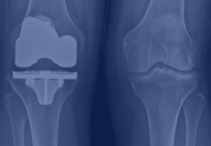 Total Joint Replacment Surgery & Robotic Assisted Knee Replacement