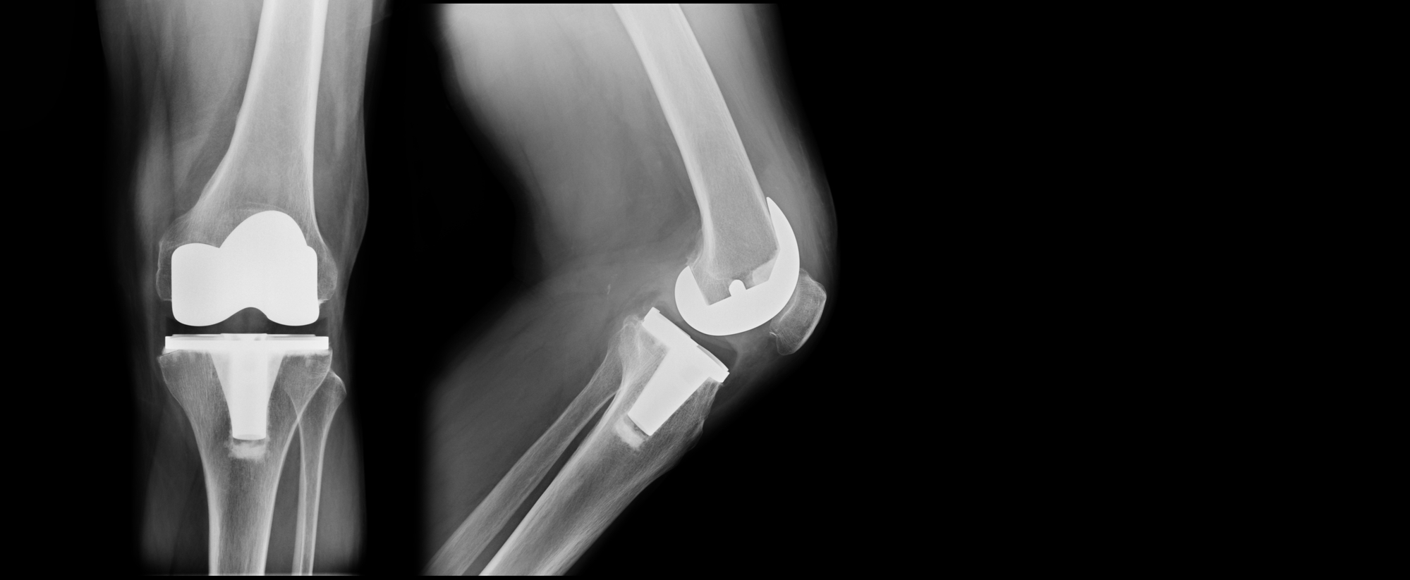 Dr. Germanuel Landfair explains 10 essential post knee replacement exercises