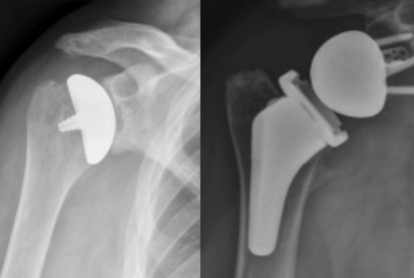 X-rays of anatomic and reverse total shoulder replacements