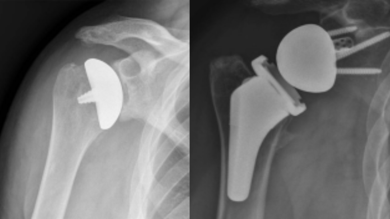 X-rays of anatomic and reverse total shoulder replacements