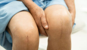 Considering A Joint Replacement In 2026 Read How Our Tampa Patients Have Benefited Post