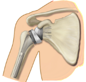 Anatomic Total Shoulder Replacement Shoulder Image