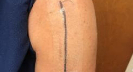 SRP Prineo Dressing Image