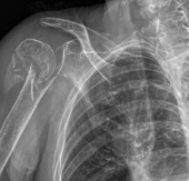 Shoulder Replacement After Fracture Shoulder Image