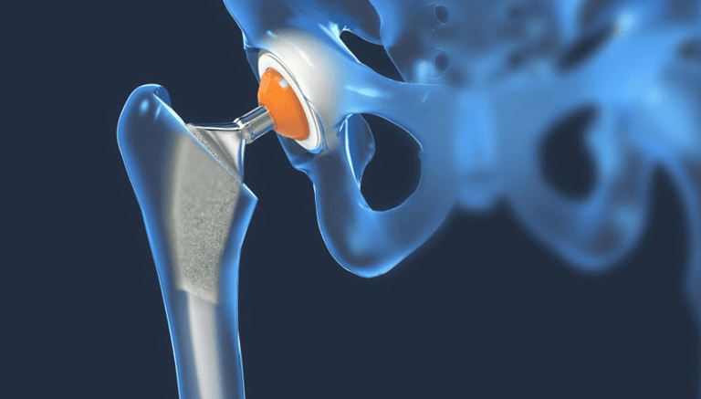 The Benefits Of Modern Hip Implants Over Older Designs post