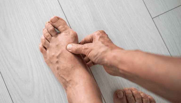 From Pain Relief To Better Balance: Why Bunion Surgery Matters post