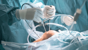 How To Tell If You Need Knee Revision Surgery In Wesley Chapel post