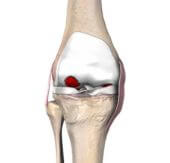 Total Knee Replacement Image