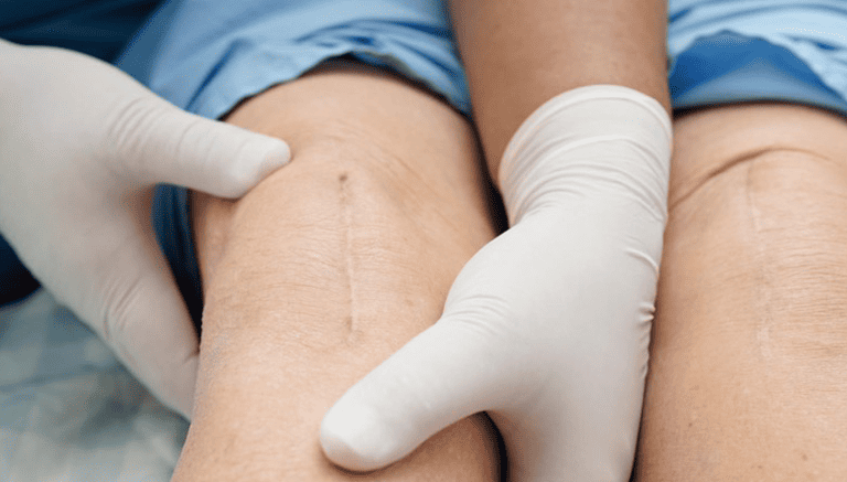 Can Jiffy Knee Surgery Really Shorten Recovery Time in Tampa? post