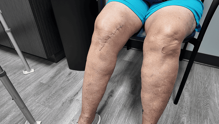 Physical Therapy After Jiffy Knee Surgery: Do You Still Need It? post