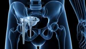 Can You Make Your Implant Last Longer? 6 Tips From Our Surgeons post