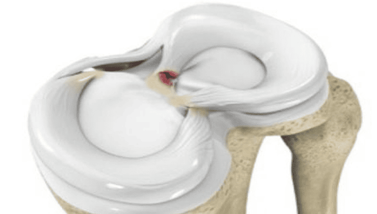 Understanding Meniscus Root Tears: A Commonly Missed Knee Injury post